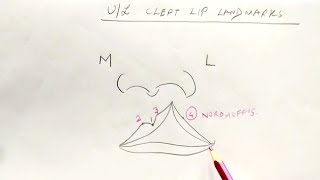 Cleft lip  part 1 [upl. by Ahcsrop]