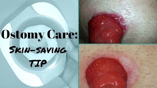 Ostomy care Healing the Skin around the Stoma [upl. by Maidel]