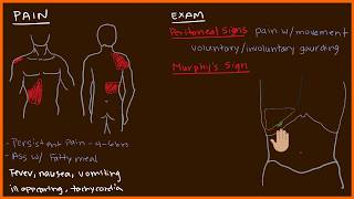 Acute Cholecystitis 23 [upl. by Mendy621]