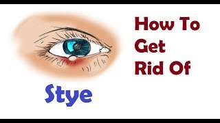 eye Disease stye and how to get rid of this Hindi [upl. by Kcered]