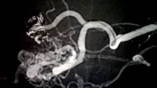 AVM embolization Vanderbilt Neurovascular Surgery [upl. by Aliuqa]