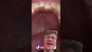 Do wisdom teeth cause crowding justorthodontics [upl. by Adnyc]