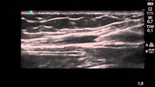 Arteria radialis catheterisation of the radial artery in realtime ultrasound [upl. by Alet142]