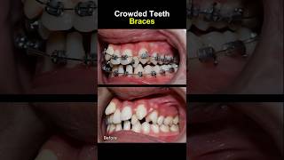 Teeth very crowded and crooked before braces orthodontist braces dentist [upl. by Joyce985]