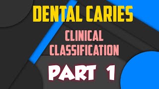 DENTAL CARIES  CLINICAL CLASSIFICATION  PART 1 [upl. by Eilegna43]