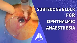 Subtenons block regional anaesthesia for ophthalmic surgery Live patient UPDATE [upl. by Yeoj]