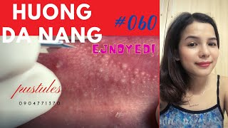 060 pustules around the lips and face  Hương Đà Nẵng [upl. by Arykat293]