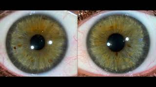 Iridology A Quick Reading Example  Scurf Ring Fermentation Signs Kidney Lymphatic Diathesis [upl. by Schuster]