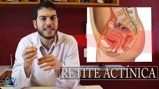 O que é Retite Actínica Retite por radioterapia [upl. by Vaenfila389]