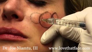 Juverderm Voluma 5 Minute Cheeks by Dr Joe Niamtu III [upl. by Ahsino]