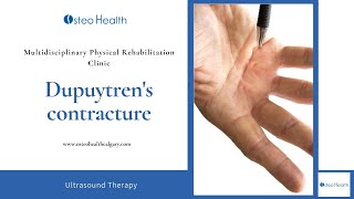 Dupuytrens contracture treatment with Ultrasound Therapy [upl. by Nogaem]