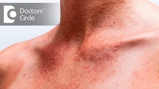 How to avoid and treat Summer Rashes and Stings  Dr Rajdeep Mysore [upl. by Onitrof200]