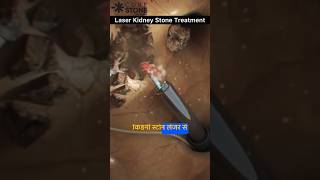 Kidney stone removal  Kidney stone treatment  laser treatment  Rirs  shorts curestone [upl. by Enwahs]