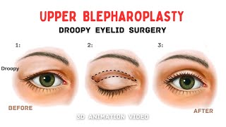 Droopy Upper Eyelid Surgery  Blepharoplasty 👁️ [upl. by Akcira]