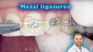 Braces preformed twisted ligature amp figure of 8 stainless steel ligating metal ligature placing on [upl. by Dobrinsky952]