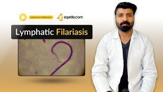 Lymphatic Filariasis  Medicine Lectures  Medical Student  VLearning  sqadiacom [upl. by Brana]