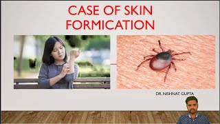 CASE OF SKIN FORMICATION by Dr NISHANT GUPTA [upl. by Rasia318]