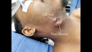 Tooth Pus Extraction Submandibular Abscess Unleashed [upl. by Rebeka]