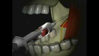 Mandibular Anesthesia  Inferior Alveolar Nerve Block [upl. by Refynnej]