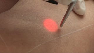 Epilation Laser Paris  Précautions après une séance [upl. by Yenitsed]