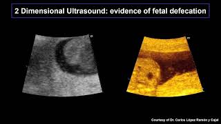 12  Meconiumstained amniotic fluid [upl. by Gayl]