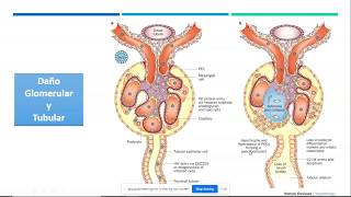 Glomerulopatía Asociada al VIH 2020 05 29 08 03 Nefrología por Marianny Peña HIVAN NAVIH [upl. by Elak951]