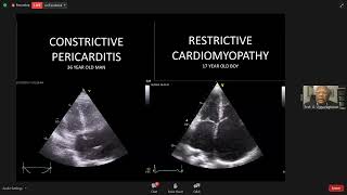 Constrictive Pericarditis amp Restrictive Cardiomyopathy Echo Update [upl. by Dazhahs]