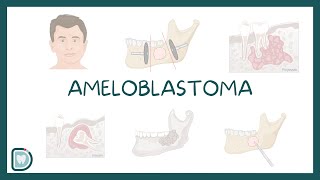 Understanding Ameloblastoma Causes Diagnosis Types and Treatment [upl. by Trauner142]