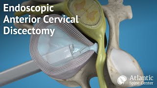 Endoscopic Anterior Cervical Discectomy [upl. by Nirret480]