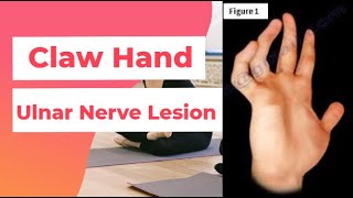 Claw Hand  Ulnar Nerve Lesion  PhysiotherapyKnowledge [upl. by Aldora]