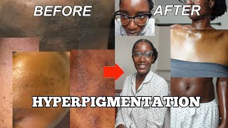 Selfcare Saturday EP 2Night Routine Secrets to Fading Hyperpigmentation [upl. by Neddra]