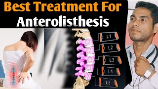 anterolisthesis l5 s1 treatment Spondylolisthesis grade 1 treatment exercises grade 2 l4 L5 Hindi [upl. by Silliw]