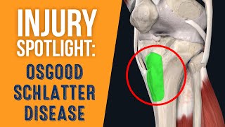 What is OsgoodSchlatter Disease [upl. by Yeldoow]