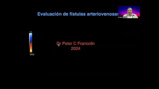 28 Evaluación de fístulas para hemodiálisis  Dr Francolin [upl. by Sotos]