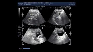 Thickwalled Gallbladder Hepatic Mass with Hepatic parenchymal disease and ascites [upl. by Oab661]