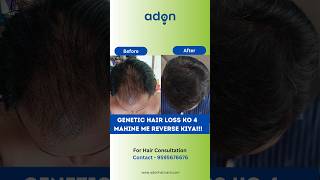 4 Months regrowth in Genetic Hair Loss  Reverse genetic hair loss viral shorts [upl. by Eilloh]