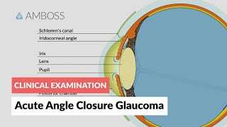 Acute Angle Closure Glaucoma [upl. by Atoked]