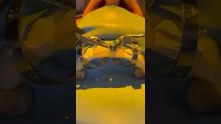 The cementation process for two porcelain veneers veneers veneers cosmeticdentistry [upl. by Dnomsad]