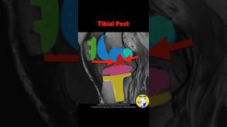 Fig 5D04 MRI Findings of Posterior Stabilized TKA Part 2 [upl. by Maynord]