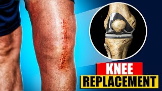 Total Knee Replacement Surgery 3D Animation  3D Animation of a Knee Replacement  Joint Replacement [upl. by Hurlee]