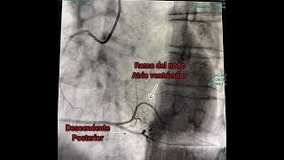 ANATOMÍA DE LAS ARTERIAS DEL CORAZÓN Arterias coronarias [upl. by Molohs]