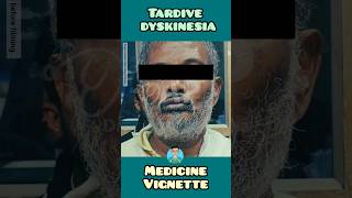 Tardive Dyskinesia real clinical video for USMLE NEET PG NCLEX INICET medical clinical video [upl. by Munster]