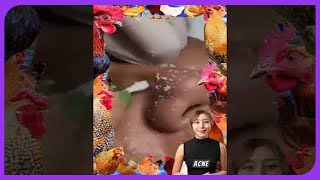 Satisfying Blackheads Removal Big Blackheads Popping on Skin in 2024 [upl. by Annair]