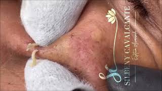 ACNE TREATMENT  Super Satisfying blackheads  004 [upl. by Kamila]