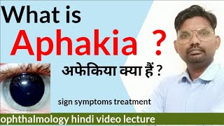 aphakia treatment  what is aphakia  aphakia and Pseudophakia  aphakia ophthalmologyhindi [upl. by Adiam]