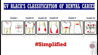 GV Blacks Classification of Dental Caries [upl. by Lainad]