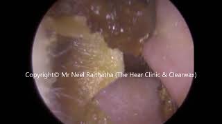 242  Soft Ear Wax Removal using Jobson Horne  Mr Neel Raithatha The Hear Clinic [upl. by Watkins]