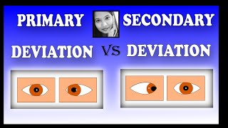 Primary Deviation Vs Secondary Deviation  Squint Simplied for Medical Students [upl. by Leunam]