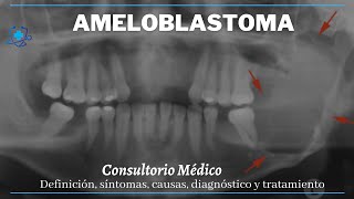 Ameloblastoma Descripción general Síntomas Causas y Tratamiento 👨‍⚕️ Consultorio Médico [upl. by Itsim]