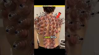 Cupping Therapy ।shorts facts [upl. by Lisle]